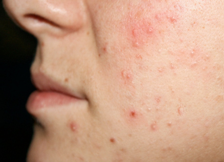 how to heal skin imperfections